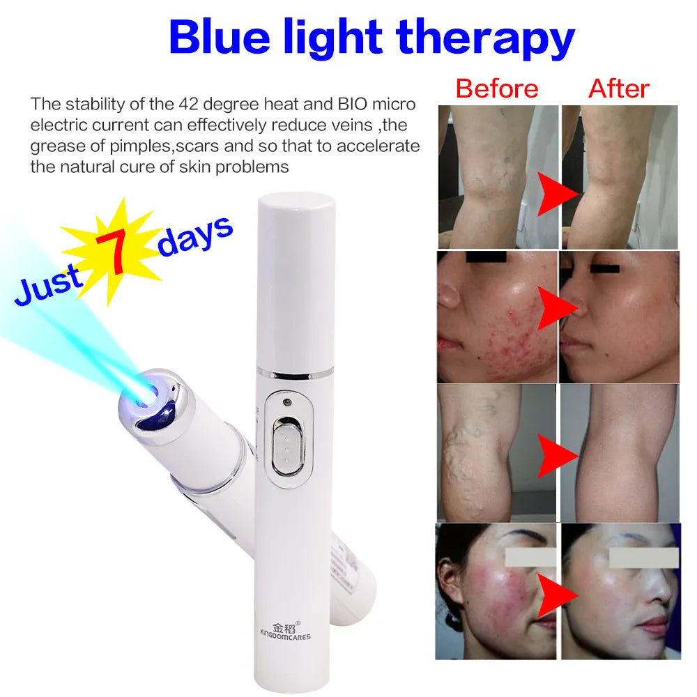 Blue Light Laser Pen  Wrinkle Removal, Anti Varicose & Spider Vein Eraser