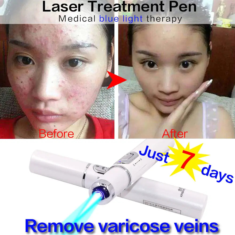 Blue Light Laser Pen  Wrinkle Removal, Anti Varicose & Spider Vein Eraser