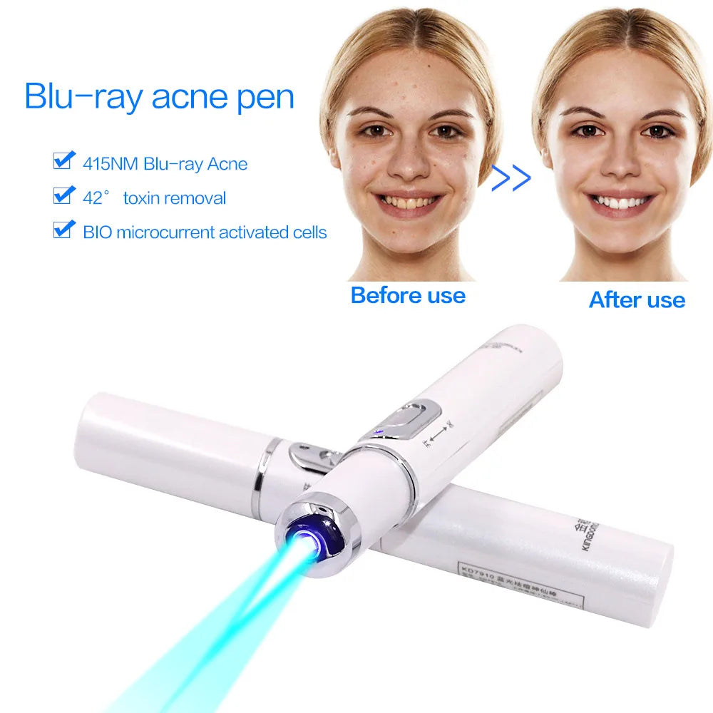 Blue Light Laser Pen  Wrinkle Removal, Anti Varicose & Spider Vein Eraser